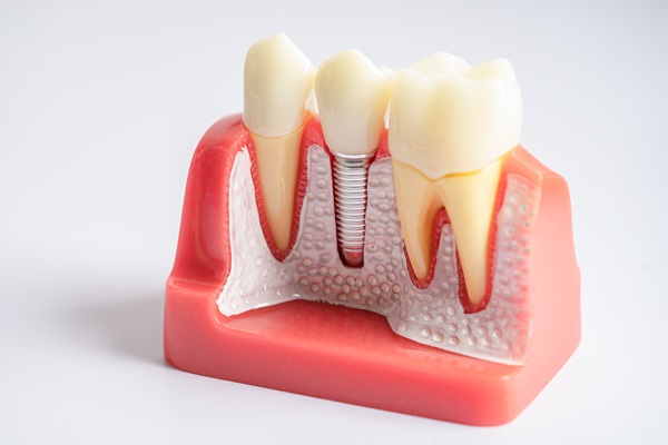 Why Choose Dental Implants Over A Dental Bridge?