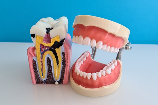 Signs Your Tooth May Need A Root Canal