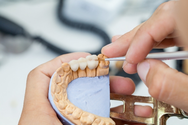 Traditional Vs  Implant Supported Dental Bridges